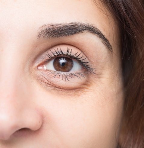 Dark Circles Under The Eyes Causes  Treatments