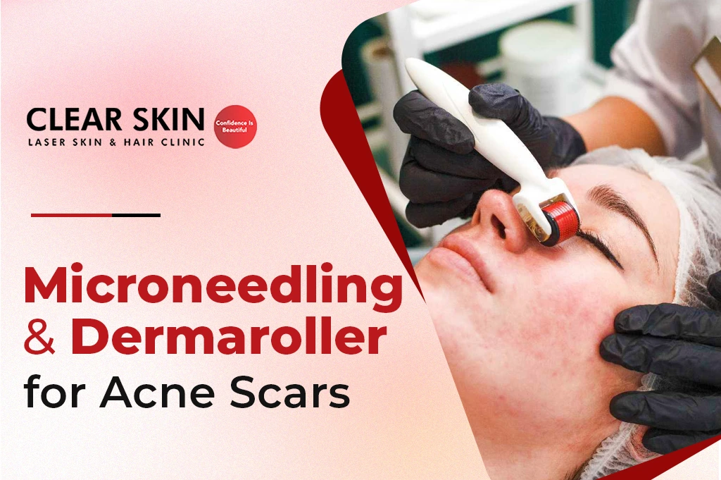 Dermaroller for Acne Scars: Are They Safe and Really Work?
