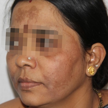 Melasma First Day Of Consultation