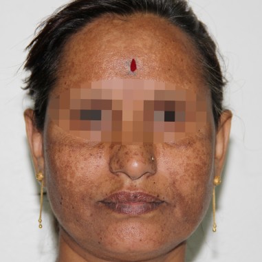 Melasma On Face: First Day Of Consultation