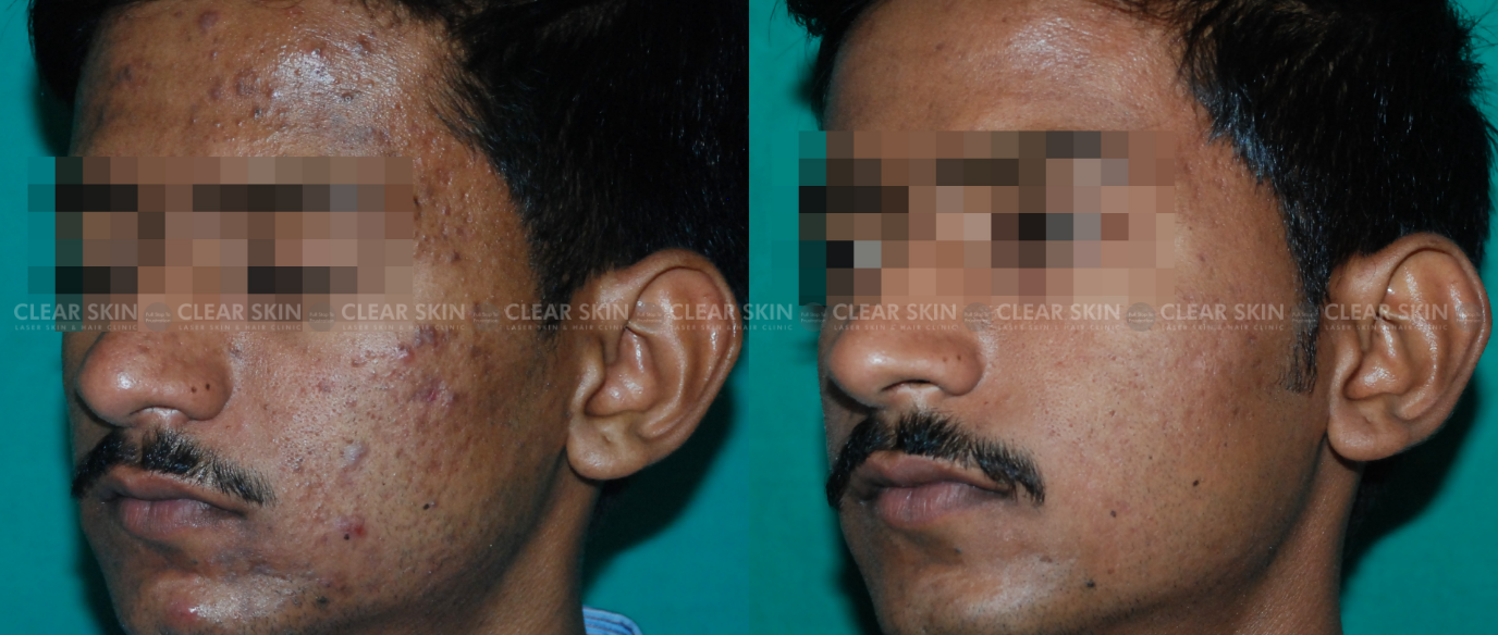 Acne Scars Images Before And After