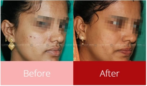 Before and After Photos of PRP Treatment 