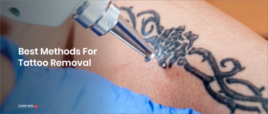 Which Laser is Best for Tattoo Removal?
