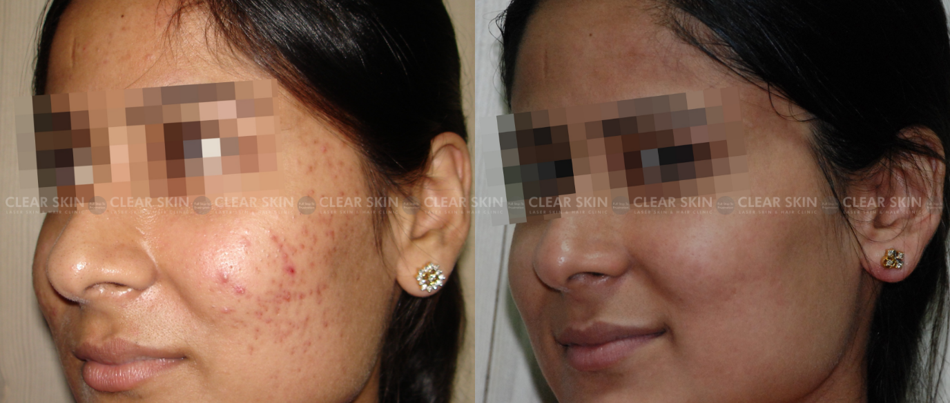 Chemical Peels Before And After Pics