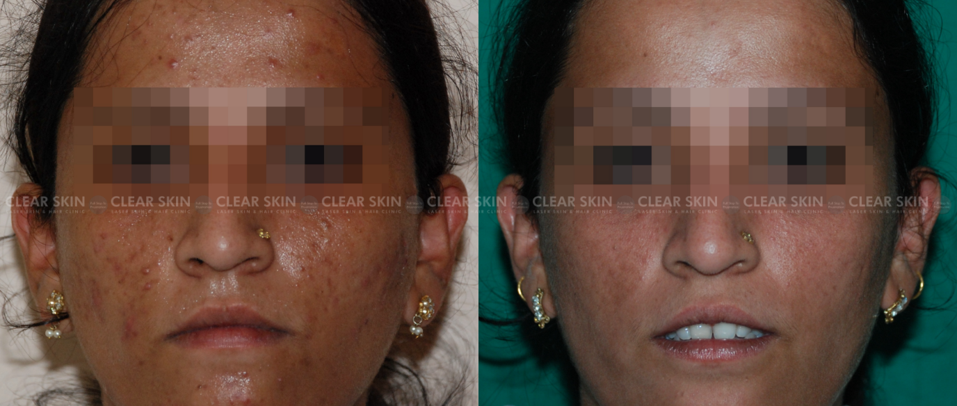 Chemical Peels Before And After Pictures