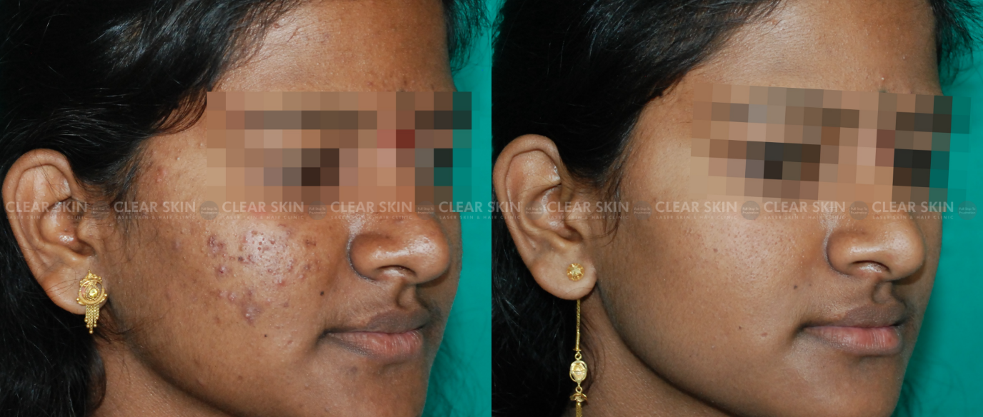 Chemical Peels Before And After Results