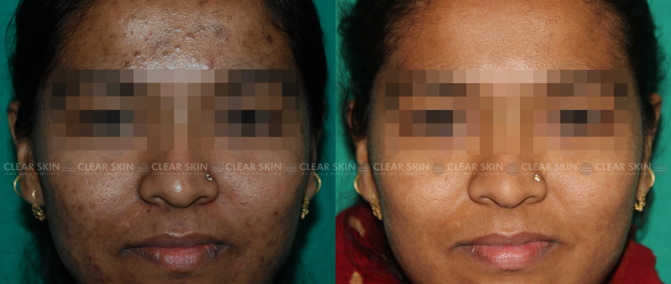 Dermapen Before And After Acne Scars