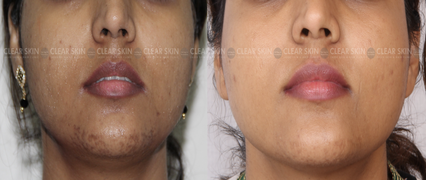 Microneedling Before And After Pictures