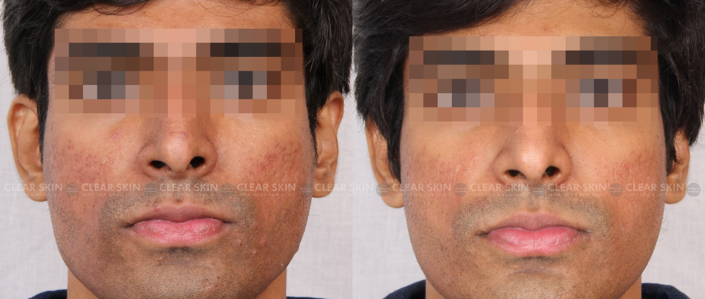 Microneedling Before And After Acne Scars