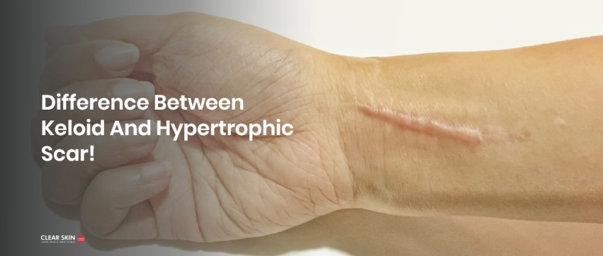 skin hypertrophy