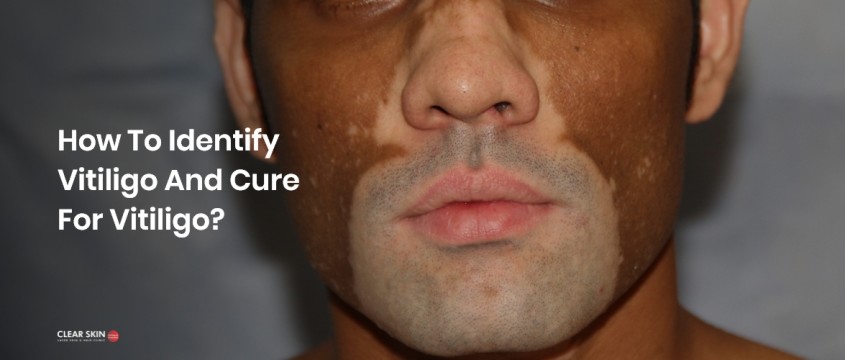 Vitiligo: Types, Symptoms, Causes & Treatment