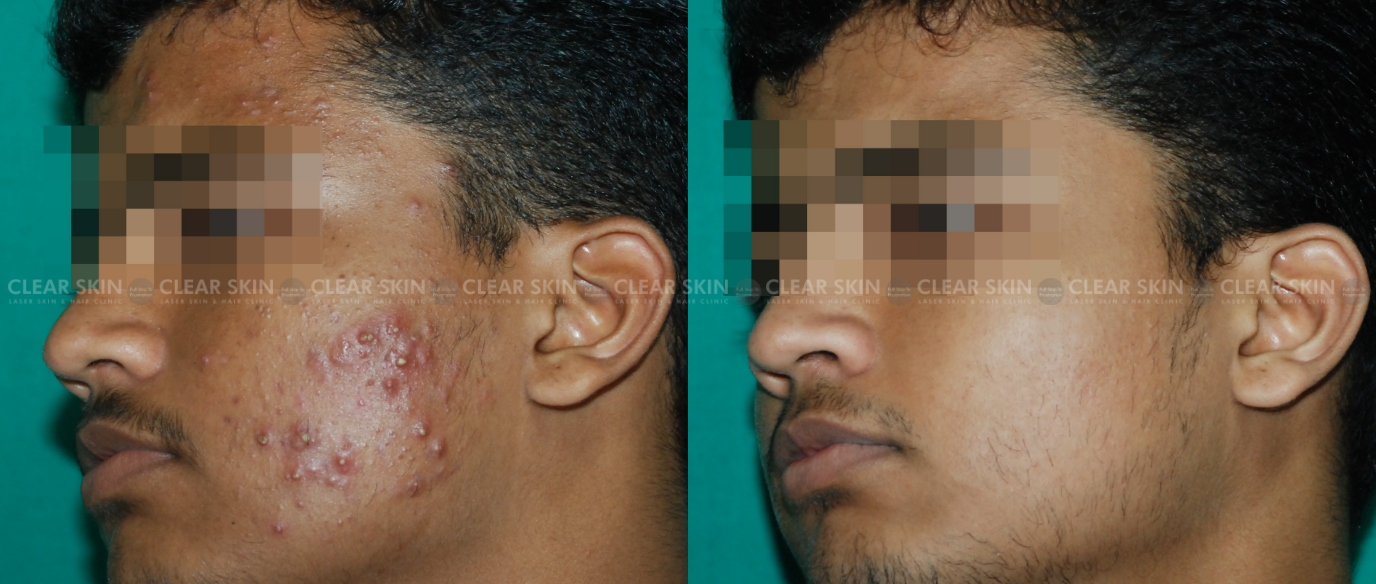 Acne Before And After Pictures