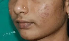 Is there a cure for acne?