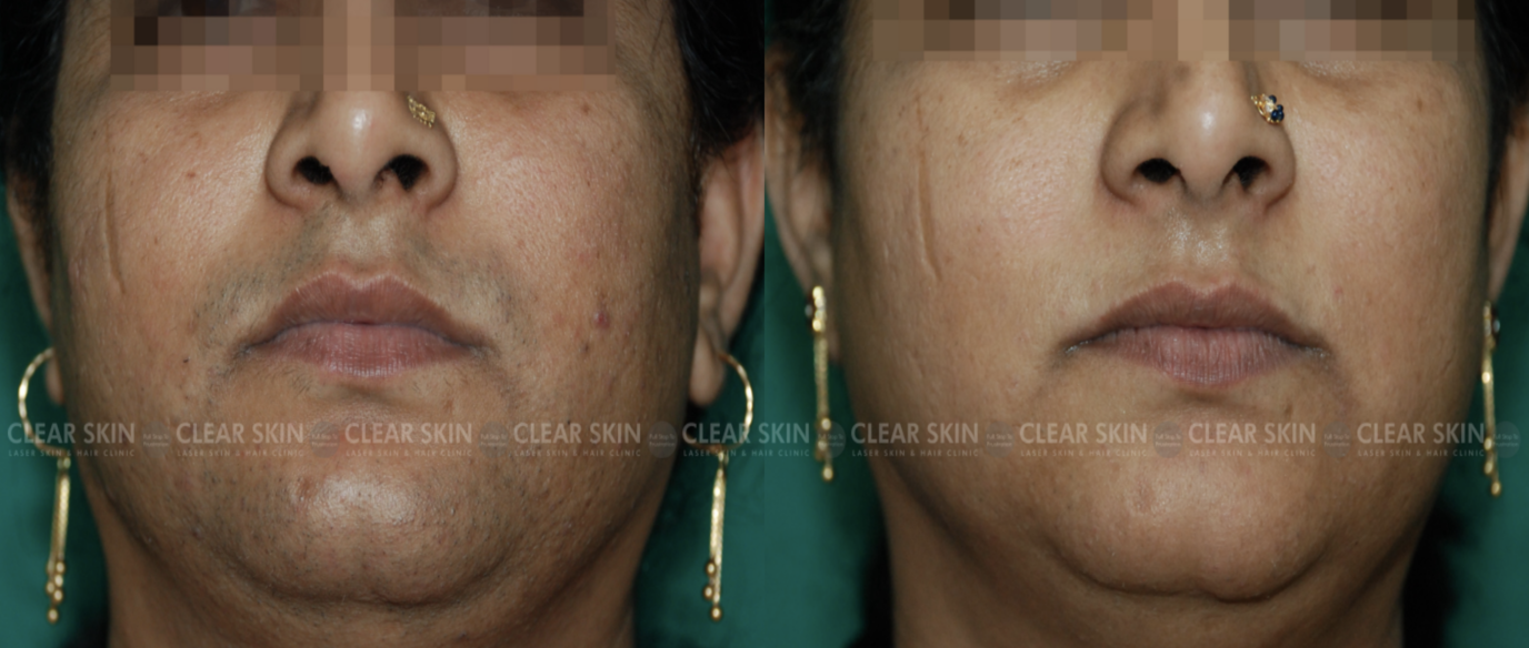 Laser Hair Removal Before And After Chin