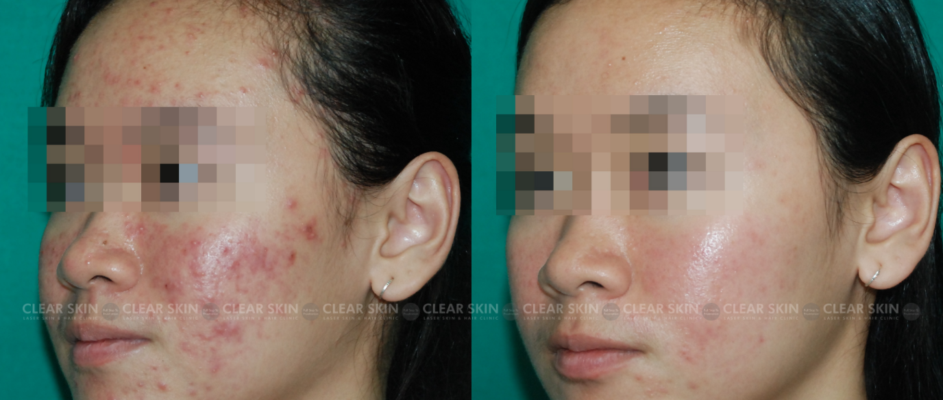 Acne Before And After Treatment