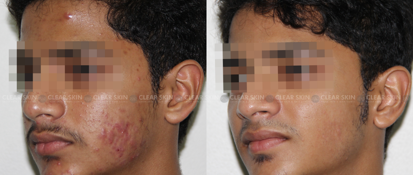 Acne Laser Treatment Before And After