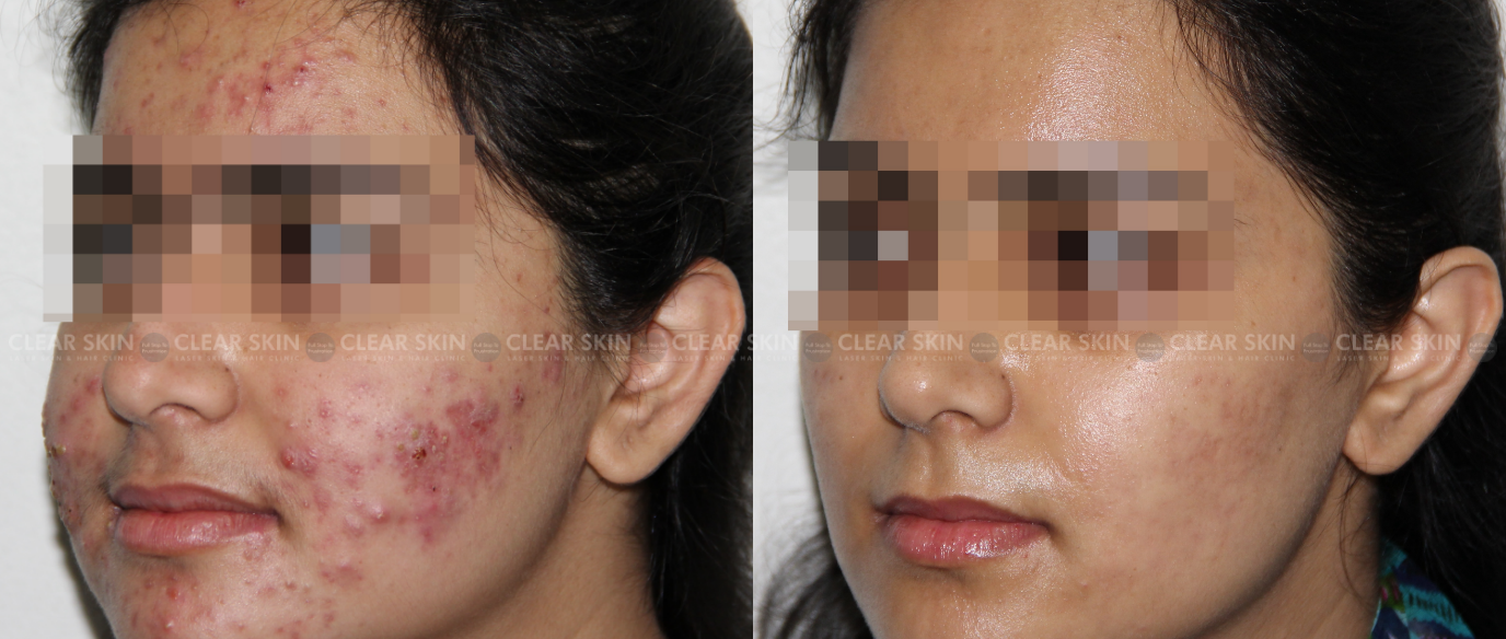 Acne Laser Treatment Before And After Pictures