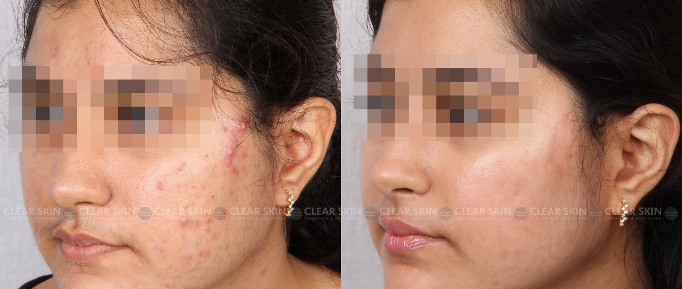 Acne Laser Treatment Before And After Photos