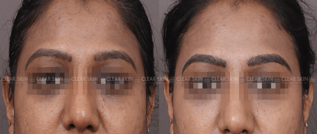 Microblading Removal Before And After