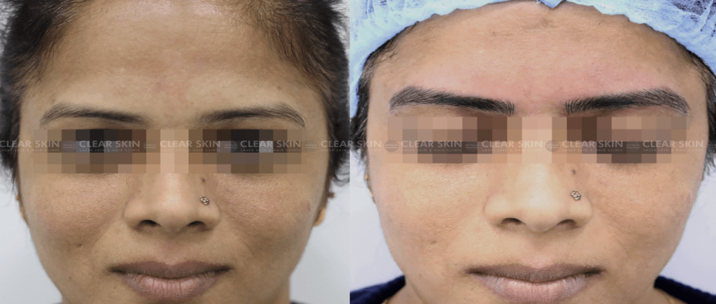 Microblading Treatment Before And After