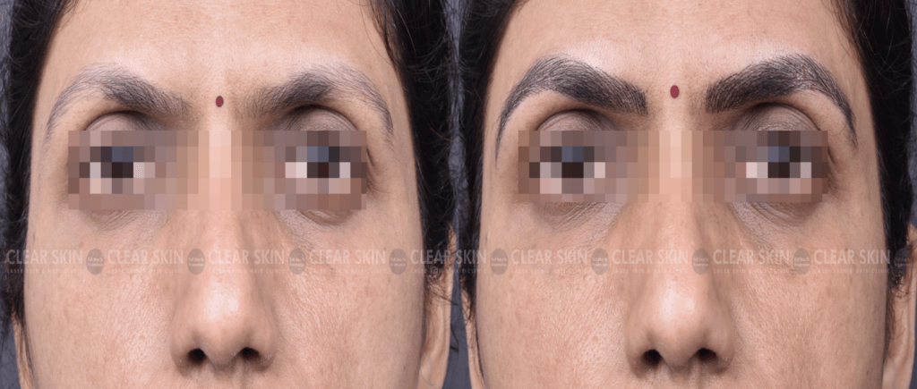 Microblading Treatment Before And After Photos