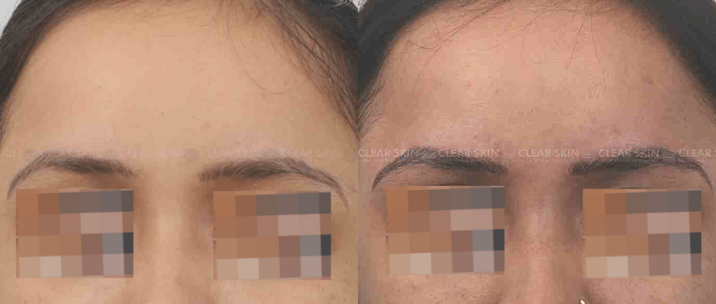 Microblading Eyebrows Before And After