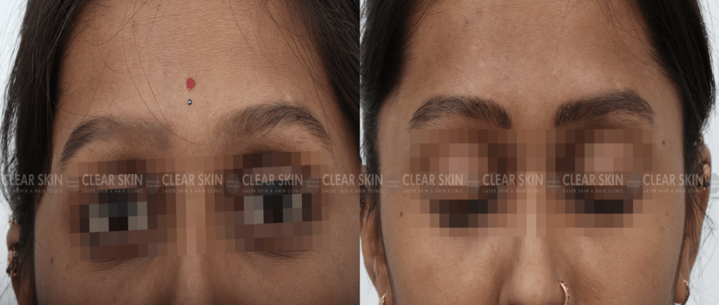 Microblading Before And After