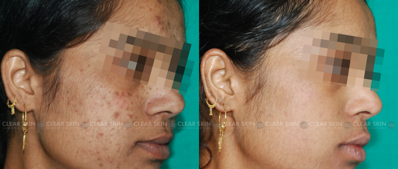 Microneedling For Acne Scars Before And After Results
