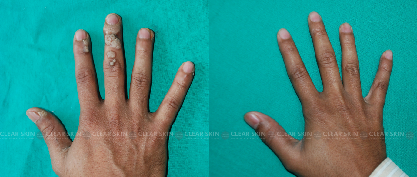 Hand Warts Before And After