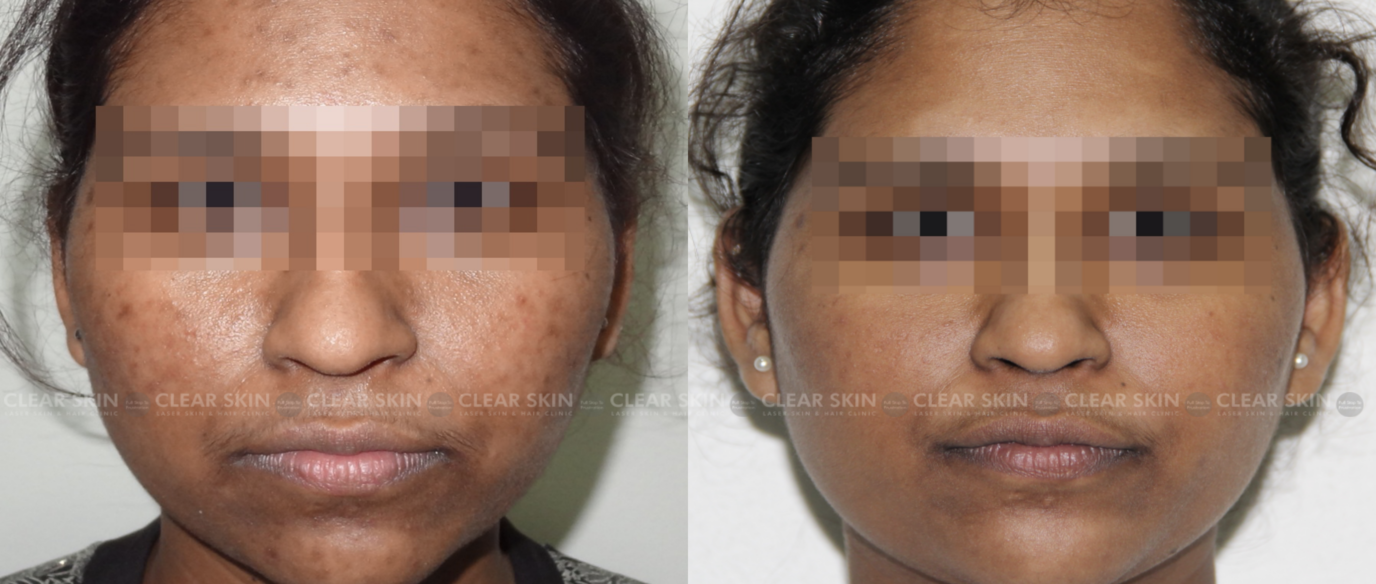 PRP For Acne Scars Before And After Photos
