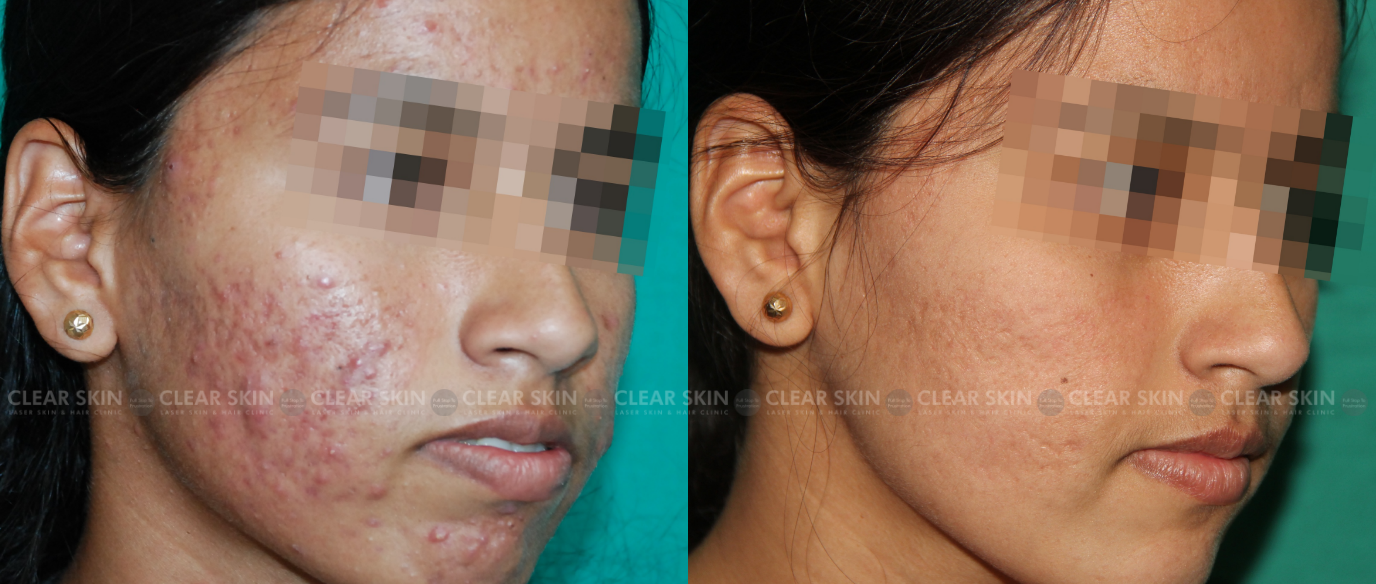 PRP For Acne Scars Before And After Images