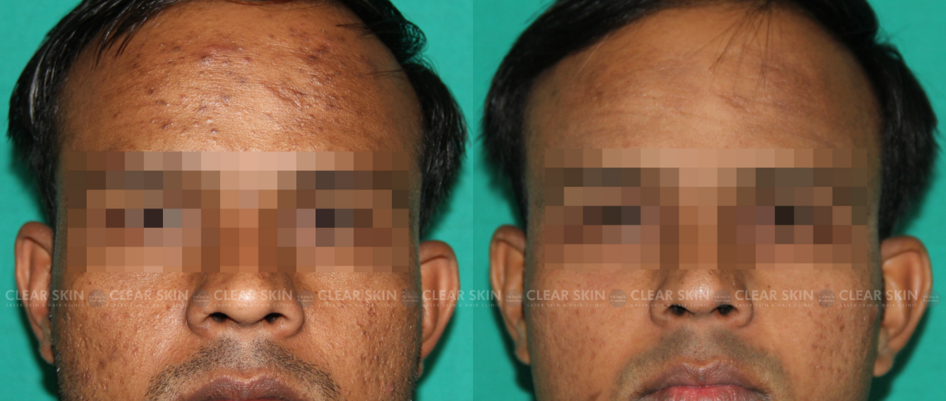 PRP For Acne Scars Before And After Pictures