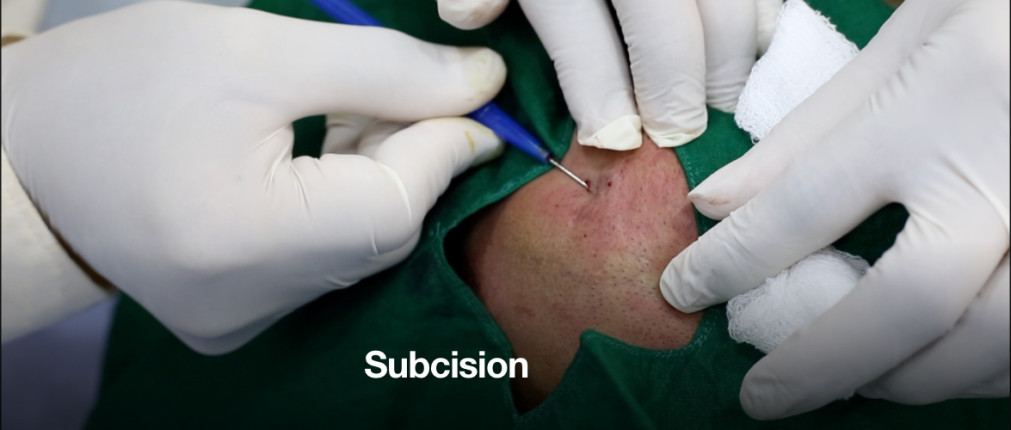 Subcision
