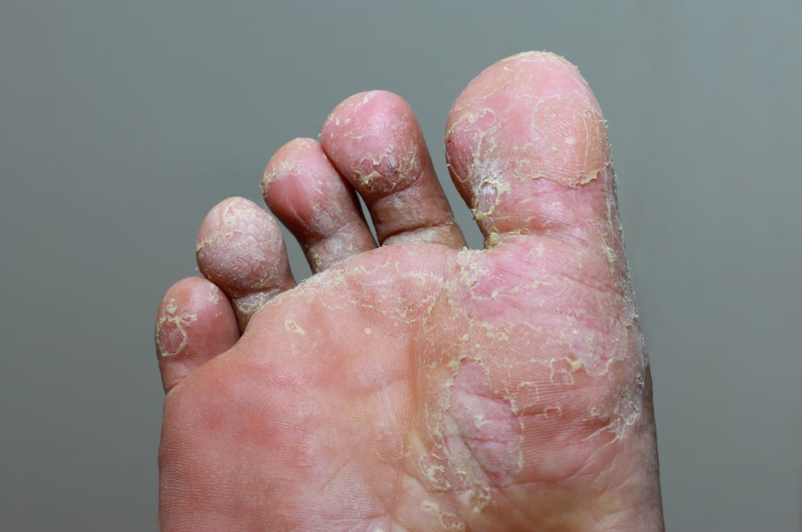 Skin Disorders in Elderly Persons: Part 5, Fungal Infections (Tinea Corporis)
