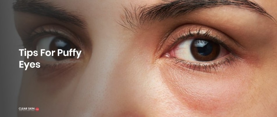 What Causes Puffy Eyes & How To Treat Them
