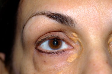 Yellow eyelid marks (xanthelasma) 'early warning sign of heart disease