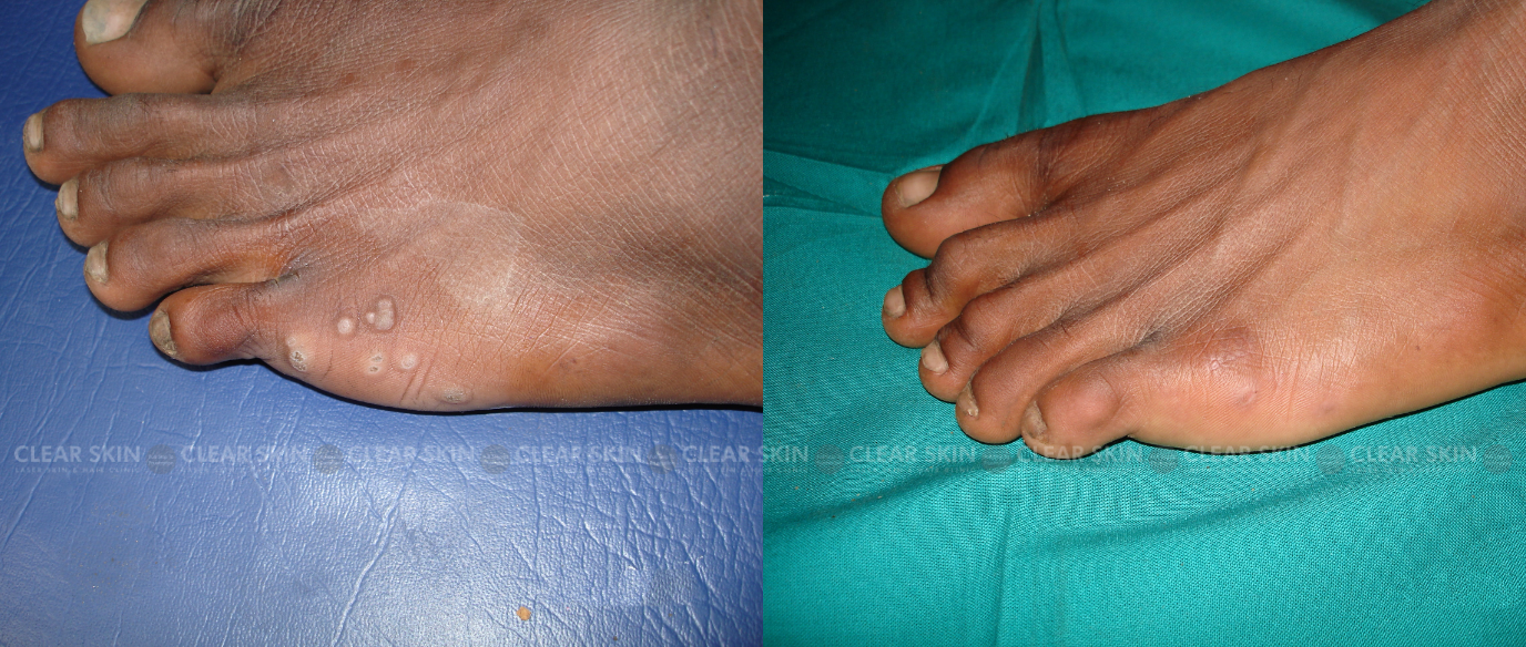 Radiofrequency Microsurgery Before And After