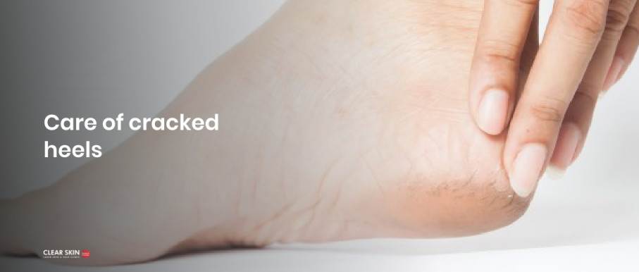 Cracked Heels - Ottawa Foot Clinic