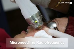Microneedling Radiofrequency