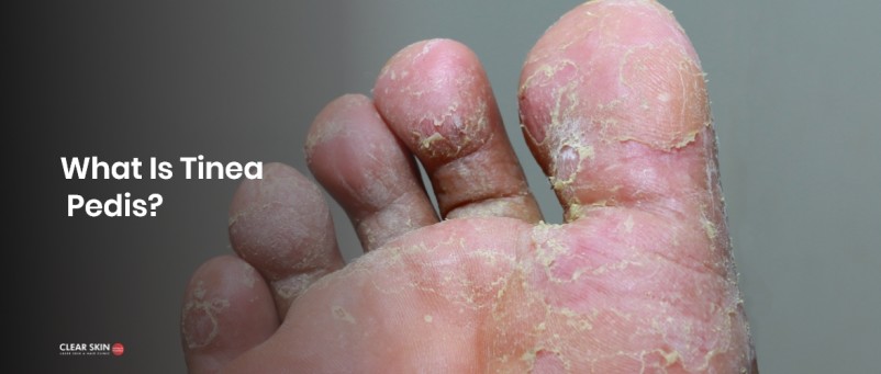 skin diseases on feet