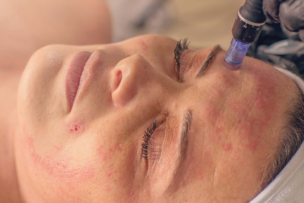 mesotherapy treatment on a woman's face