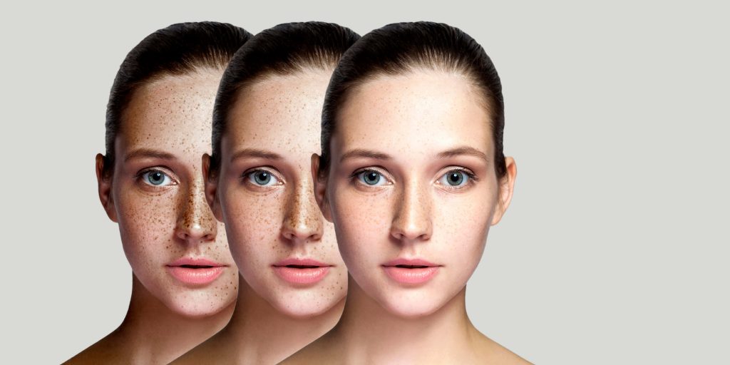 Skin pigmentation success stories