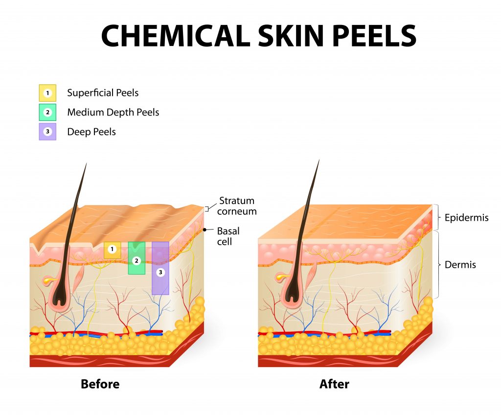 chemical peeling procedure