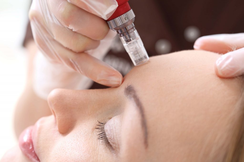 microneedling treatment on the forehead