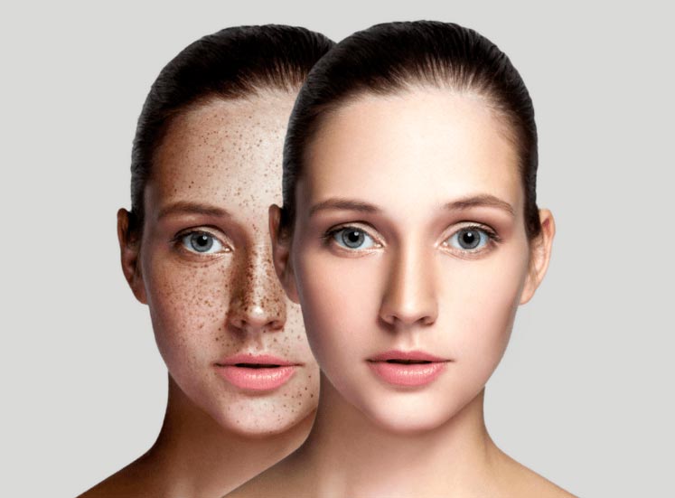Treating pigmentation issues