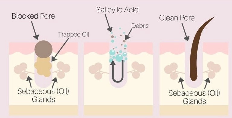 Is Salicylic Acid Suitable for All Skin Types?