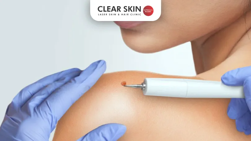 Is Laser Hair Removal Safe on Moles? Understanding Risks and Precautions