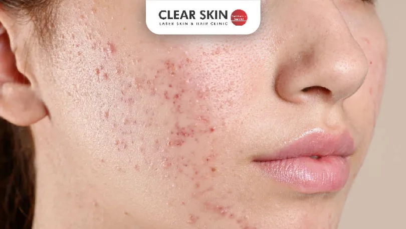 Hyperpigmentation Treatment Does It Really Help After Acne Clear Skin Pune