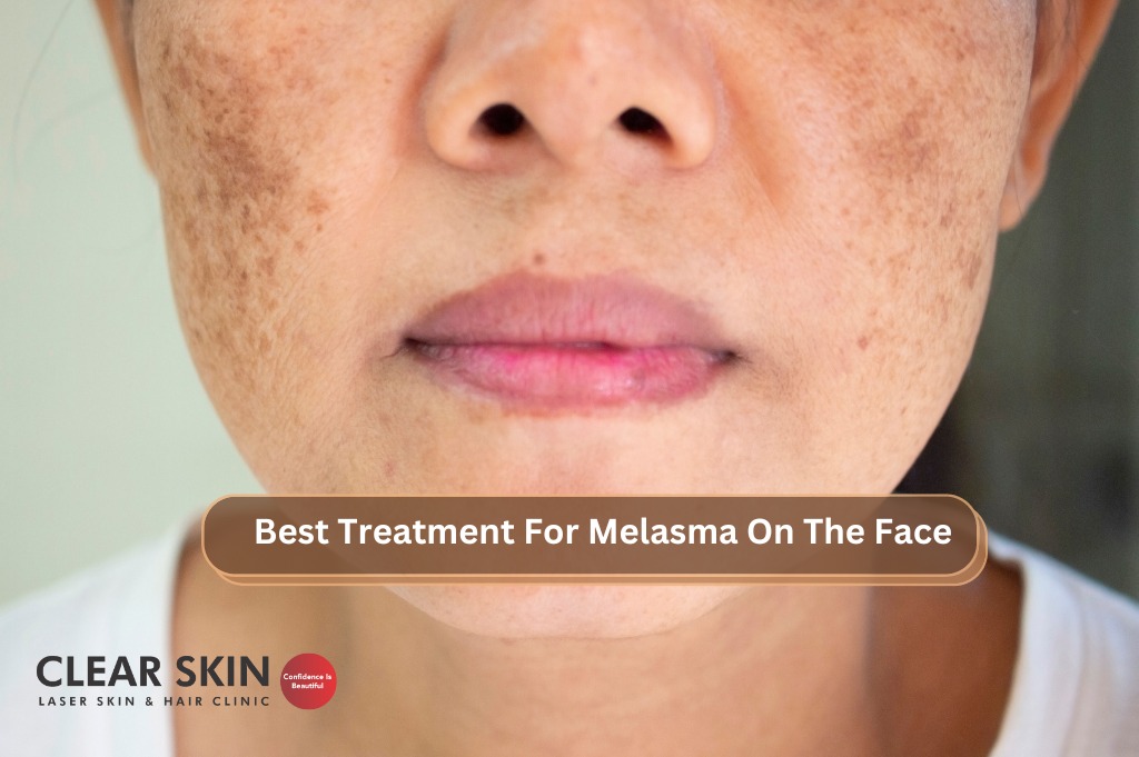 Best Treatment for Melasma on the Face