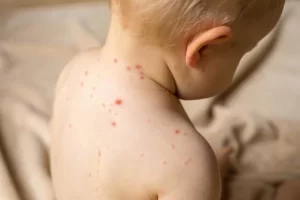 chickenpox treatment in pune